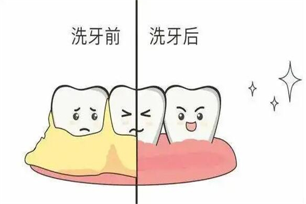 洗牙一次大概多少钱?一般200元起(主要看牙齿状况)