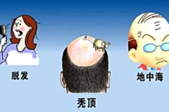 植发大约多少钱啊?3000元到15000元不等(按面积算)
