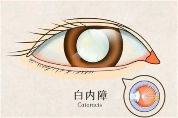 白内障手术费用大概多少钱?最低几百元(价格跨度大)