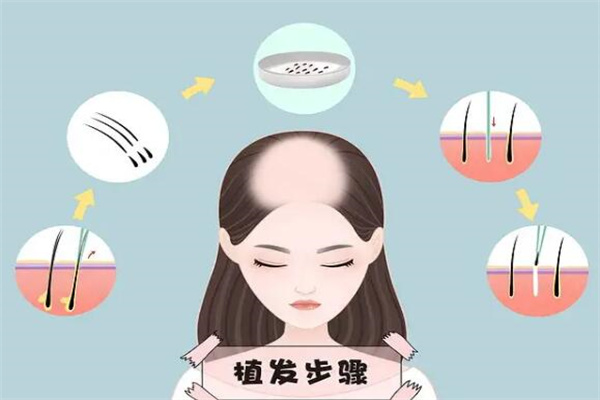 植头发得多少钱?五千到三万元不等(按毛囊数量定)