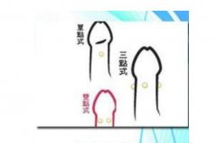 入珠是什么意思?阴茎入珠术(微整形的一种)